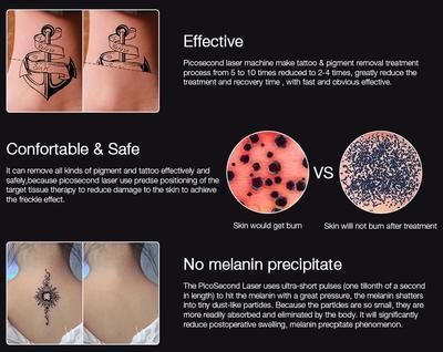 Appareil d'enlèvement de tatouage permanent au laser portable